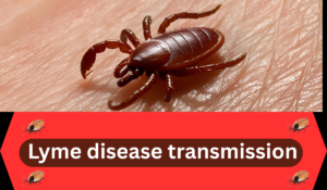 Tick on human skin - Lyme disease transmission